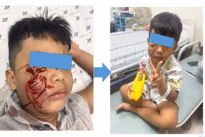 Bệnh nhi 5 tuổi bị chó cắn rách mặt.