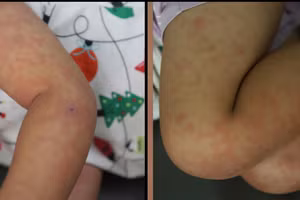 Xuất hiện ổ dịch sởi tại trường học trong tuần đầu tiên của năm mới.