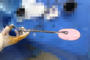 Cục xà phòng được lấy ra từ âm đạo bé gái. (Ảnh: BVCC)