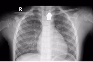 Hình ảnh chụp X-quang bệnh nhi.