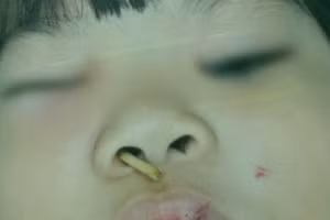 Tai nạn hy hữu bé gái 5 tuổi bị xiên thịt đâm xuyên từ mũi đến hốc mắt phải. (Ảnh: BVCC)