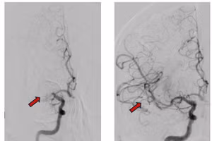 Hình ảnh chụp động mạch não cản quang trước và sau can thiệp lấy cục huyết khối cho thấy sự phục hồi tưới máu hoàn toàn. 