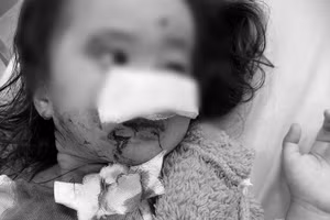 Bé gái bị chó cắn khi đang chơi ở công viên. 