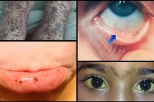 Các triệu chứng thường gặp của hội chứng Evans.