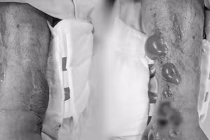 Chân bệnh nhân nổi nhiều mụn nước và biến dạng. 