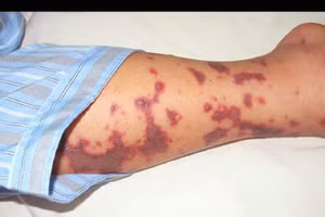 Ca tử vong do não mô cầu ở TPHCM