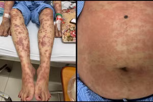 Các nốt đỏ xuất hiện trên người bệnh nhân. 