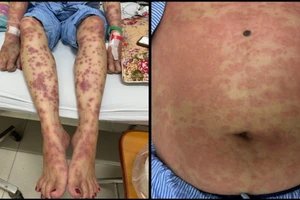 Các nốt đỏ xuất hiện trên người bệnh nhân.