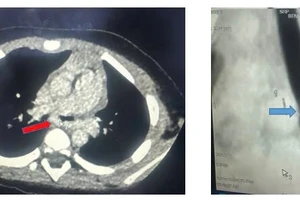 CT scan ngực mặt cắt ngang thấy động mạch phổi trái quấn hẹp khí quản gốc, mặt cắt dọc đứng thấy hẹp khí quản gốc (carina).