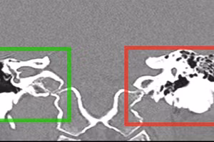 Hình ảnh khối đậm độ như xương với các thành của ống tai xương, lan vào ống tai ngoài.