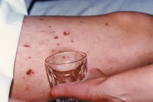 Dấu hiệu mắc bệnh viêm não mô cầu. 