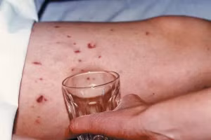 Dấu hiệu mắc bệnh viêm não mô cầu. 