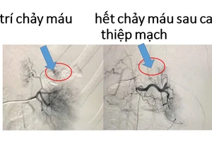 Hình ảnh chụp mạch máu xóa nền DSA hệ động mạch lách, (Ảnh: BVCC)