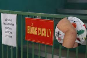 Tỷ lệ bệnh nhi mắc sởi tại TPHCM tăng cao, đã có 3 trường hợp tử vong. 