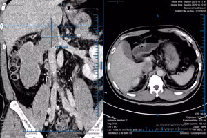 Hình ảnh khối ung thư biểu mô tế bào thận có huyết khối bướu trên phim CT-scan của người bệnh. (Ảnh: BVCC)