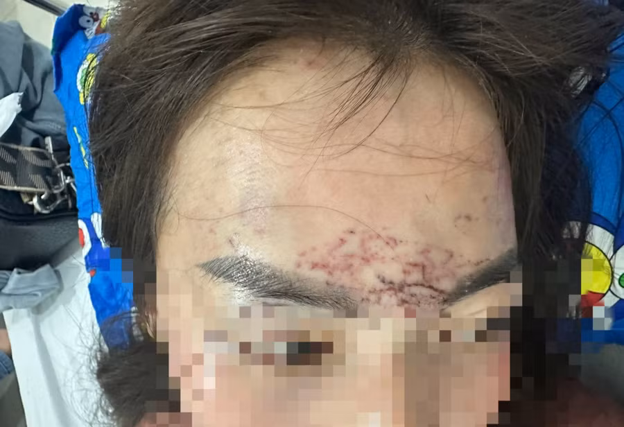 Khuôn mặt chị P.H.M có nhiều vết thương sau khi bị hành hạ.