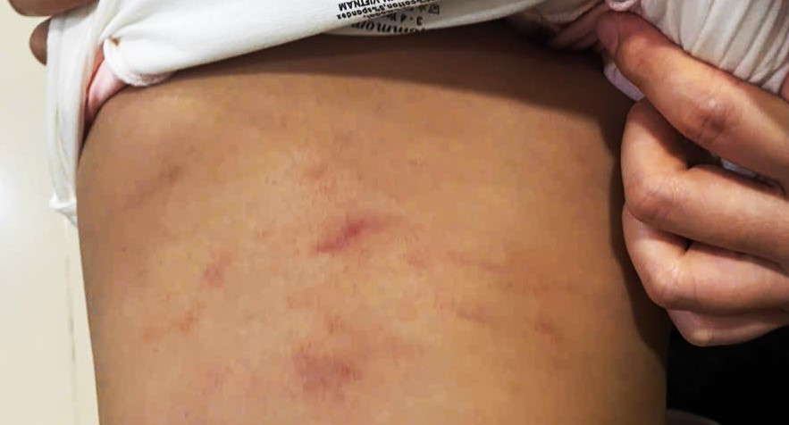 Vết thương trên mình cháu bé bị bạo hành.