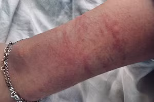 Tay nạn nhân bị nhiều vết bầm được cho là do chống cự khi bị hiếp dâm (ảnh nhân vật cung cấp).