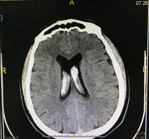 Hình ảnh xuất huyết não thất