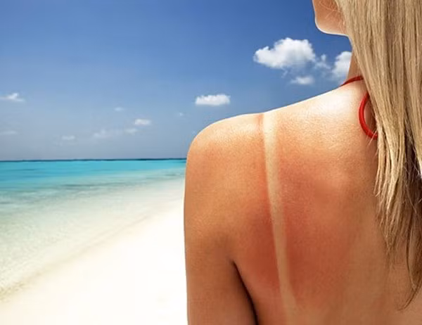 Tuyệt chiêu chữa cháy nắng cho da chị em nên biết
