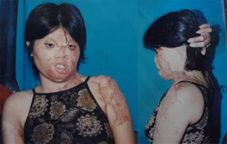 Nạn nhân của hành vi tạt axit (ảnh minh họa, theo 24h)