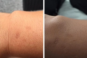 Apple Watch bị phàn nàn gây bỏng tay