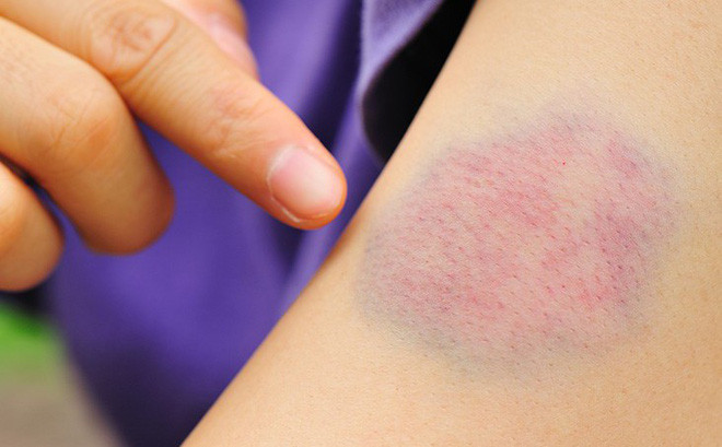 Mách bạn mẹo nhỏ giúp xóa tan vết bầm tím trên da ảnh 1 Những vết bầm tím xuất hiện trên da khiến bạn mất tự tin trong giao tiếp, ảnh hưởng đến chất lượng công việc