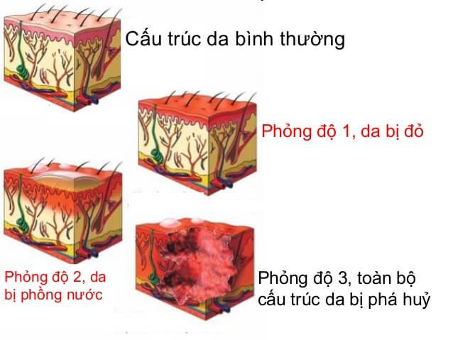 Những cách trị vết bỏng không lo để lại sẹo ảnh 3
