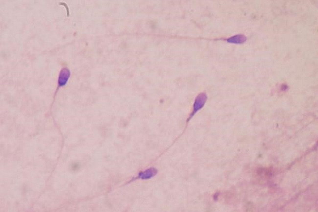 Phát hiện cấu trúc tinh trùng có thể góp phần gây vô sinh