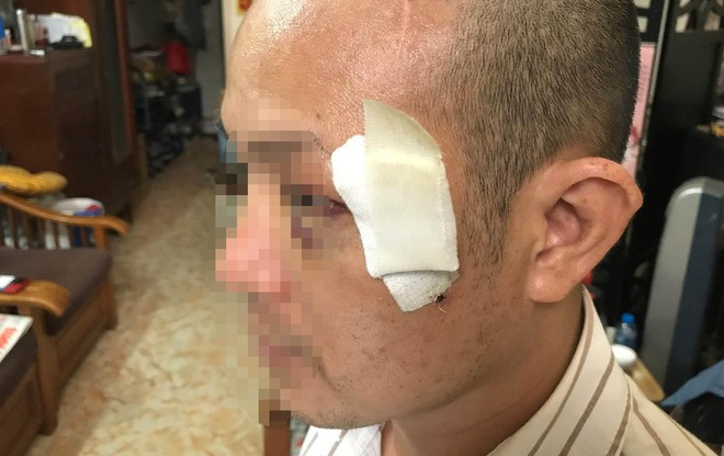 Ông Tuấn bị rách da vùng mắt, phải khâu khoảng 10 mũi. Ảnh Zing.vn