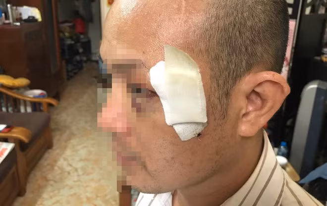 Ông Tuấn bị rách da vùng mắt, phải khâu khoảng 10 mũi. Ảnh Zing.vn