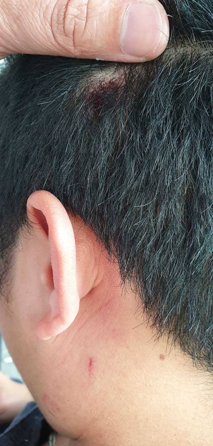 Nhiều vết thương ở vùng đầu của phóng viên T sau khi bị hành hung... Nhiều vết thương ở vùng đầu của phóng viên T sau khi bị hành hung...