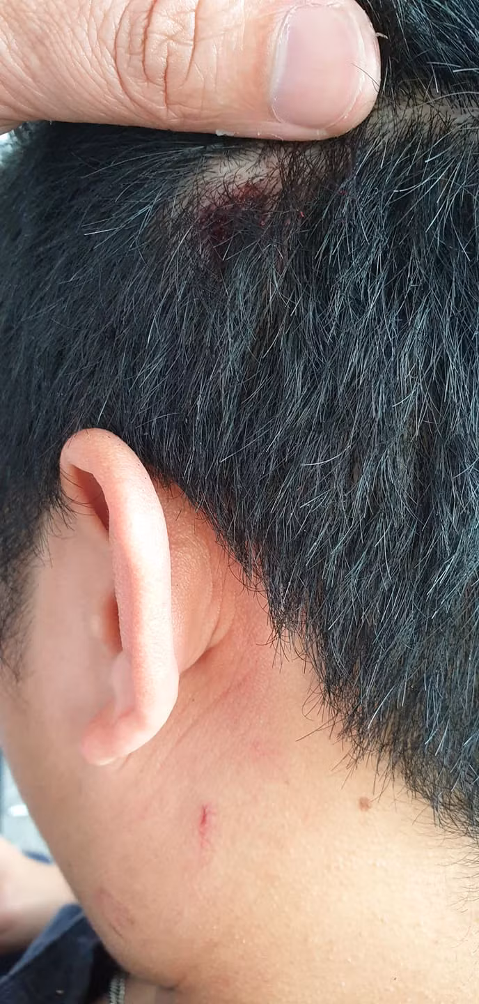 Nhiều vết thương ở vùng đầu của phóng viên T sau khi bị hành hung... Nhiều vết thương ở vùng đầu của phóng viên T sau khi bị hành hung...