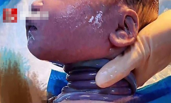 Em bé chào đời với 6 vòng dây rốn quấn cổ. Em bé chào đời với 6 vòng dây rốn quấn cổ.