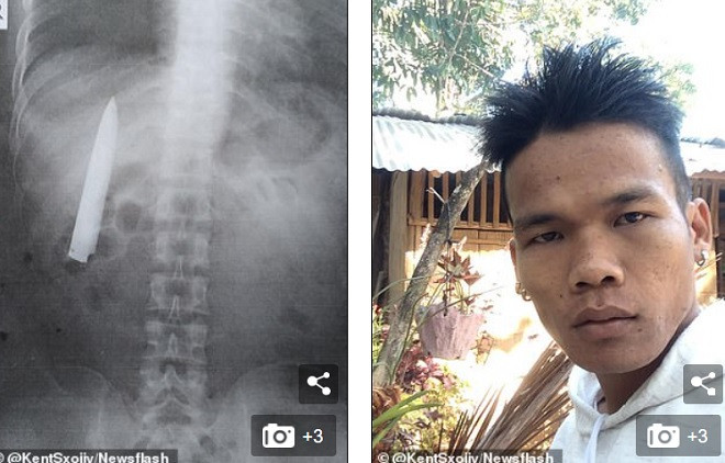 Thanh niên Philippines bị dao đâm xuyên ngực mà không hay biết. Thanh niên Philippines bị dao đâm xuyên ngực mà không hay biết.