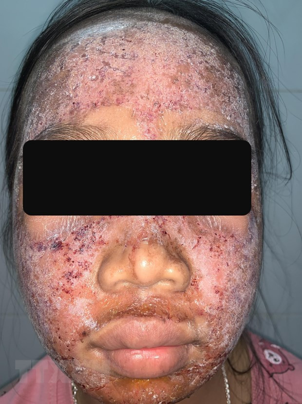 Da mặt thiếu nữ 17 tuổi bị hủy hoại sau khi sử dụng sản phẩm lột da sinh học không rõ nguồn gốc. (Nguồn: TTXVN). Da mặt thiếu nữ 17 tuổi bị hủy hoại sau khi sử dụng sản phẩm lột da sinh học không rõ nguồn gốc. (Nguồn: TTXVN).
