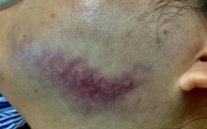 Chị T bị hành hung khiến bầm tím mặt.