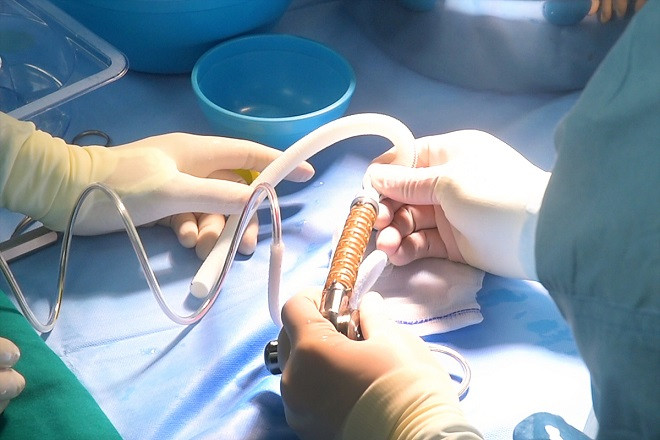 Với sự chuẩn bị kỹ lưỡng, ekip đa chuyên khoa Bệnh viện Vinmec Times City đã phối hợp nhuần nhuyễn trong suốt thời gian hơn 5h phẫu thuật cấy ghép tim bán phần nhân tạo cho y tá Vi Thi Tân.