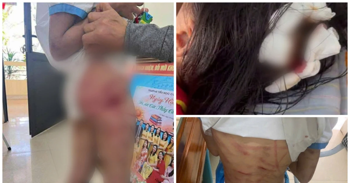 Công an điều tra vụ bé gái lớp 5 bị cha dượng bạo hành ở Hà Tĩnh