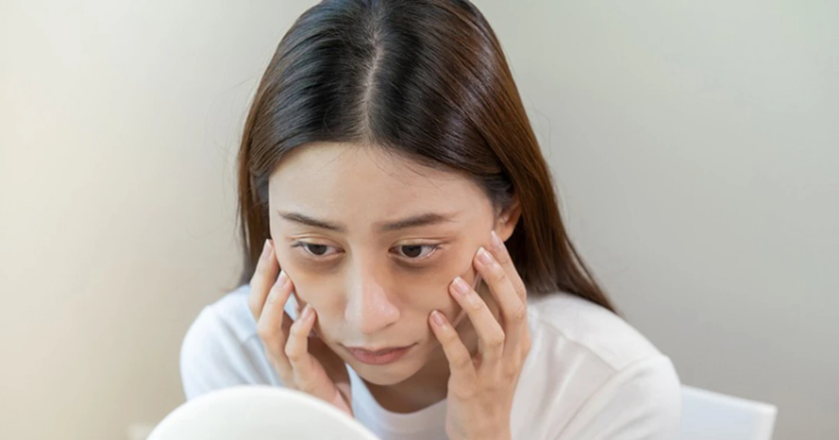 Quầng thâm dưới mắt cảnh báo bệnh gì?
