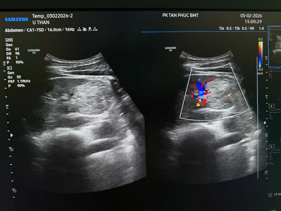 Đi khám định kỳ, người đàn ông 32 tuổi phát hiện ung thư thận. (Ảnh: NVCC)