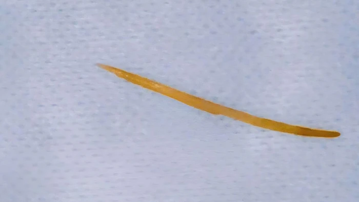 Xương cá dài 5cm được phát hiện khi bệnh nhân đi khám.