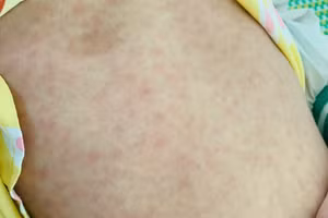 Dấu hiệu sốt phát ban ở trẻ. Ảnh: V.X