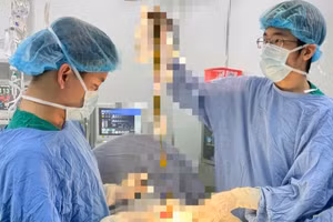 Bác sĩ phẫu thuật lấy búi tóc ra khỏi cơ thể bệnh nhi. Ảnh: BVCC