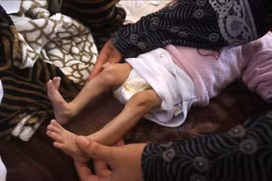 Bé gái ở Gaza đã tử vong do suy dinh dưỡng nghiêm trọng vì đói.