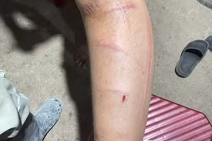 Nam sinh lớp 8 tại TP Huế bị xích chân và đánh đập, trên người có nhiều vết thương.