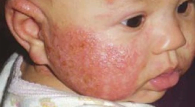 Bệnh chàm ở trẻ sơ sinh