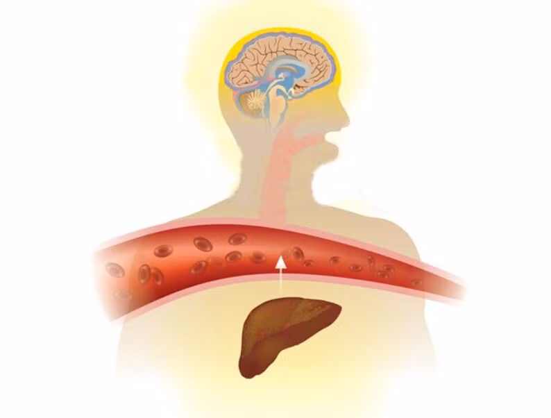 Tổn thương ở gan có thể dẫn đến tổn thương thần kinh