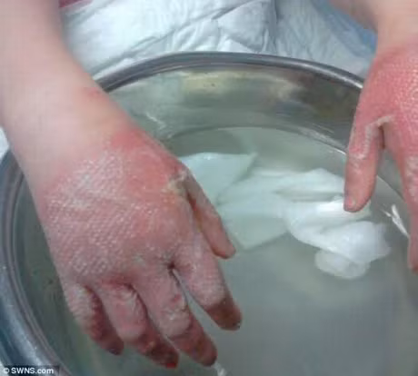 Bai thuoc tri bong, tri mun khong ngo tu tro bep - Anh 3