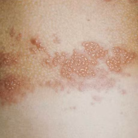 Bai thuoc tri bong, tri mun khong ngo tu tro bep - Anh 2